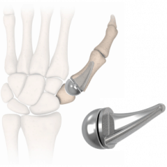 Modular Thumb Implant - MedQuest Medical Inc.